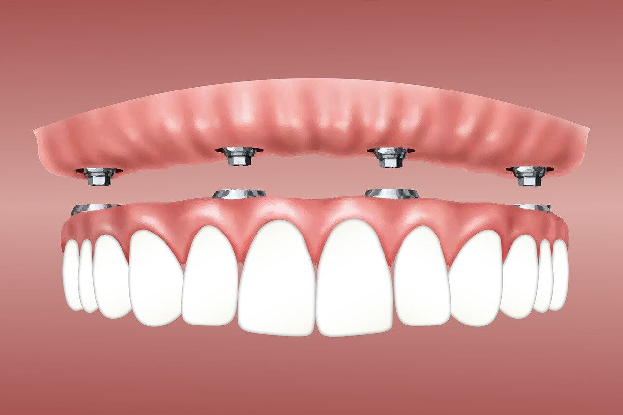 What is All-on-6 Dental Implant?