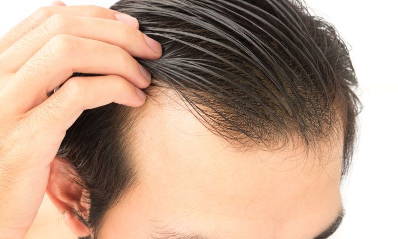 What are some important considerations during a hair transplant?