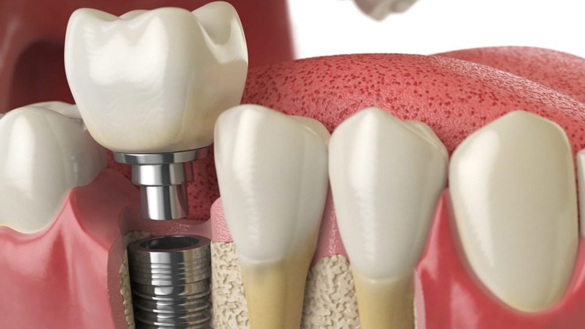 What is dental implant?