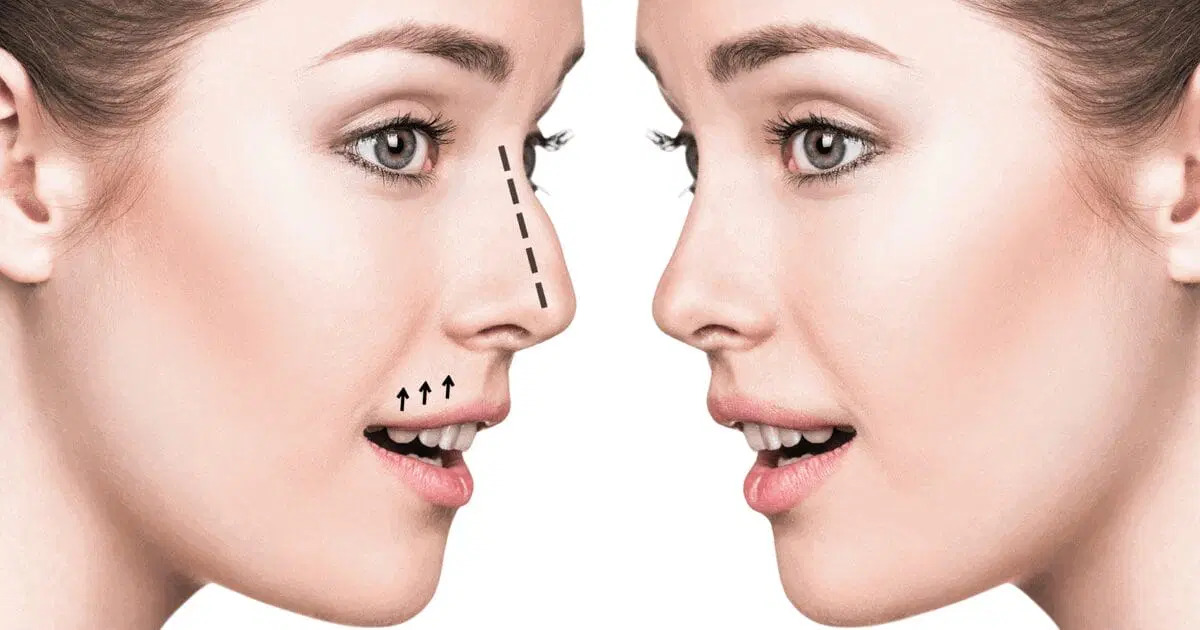 Rhinoplastie Stappen, Voordelen en Voordelen