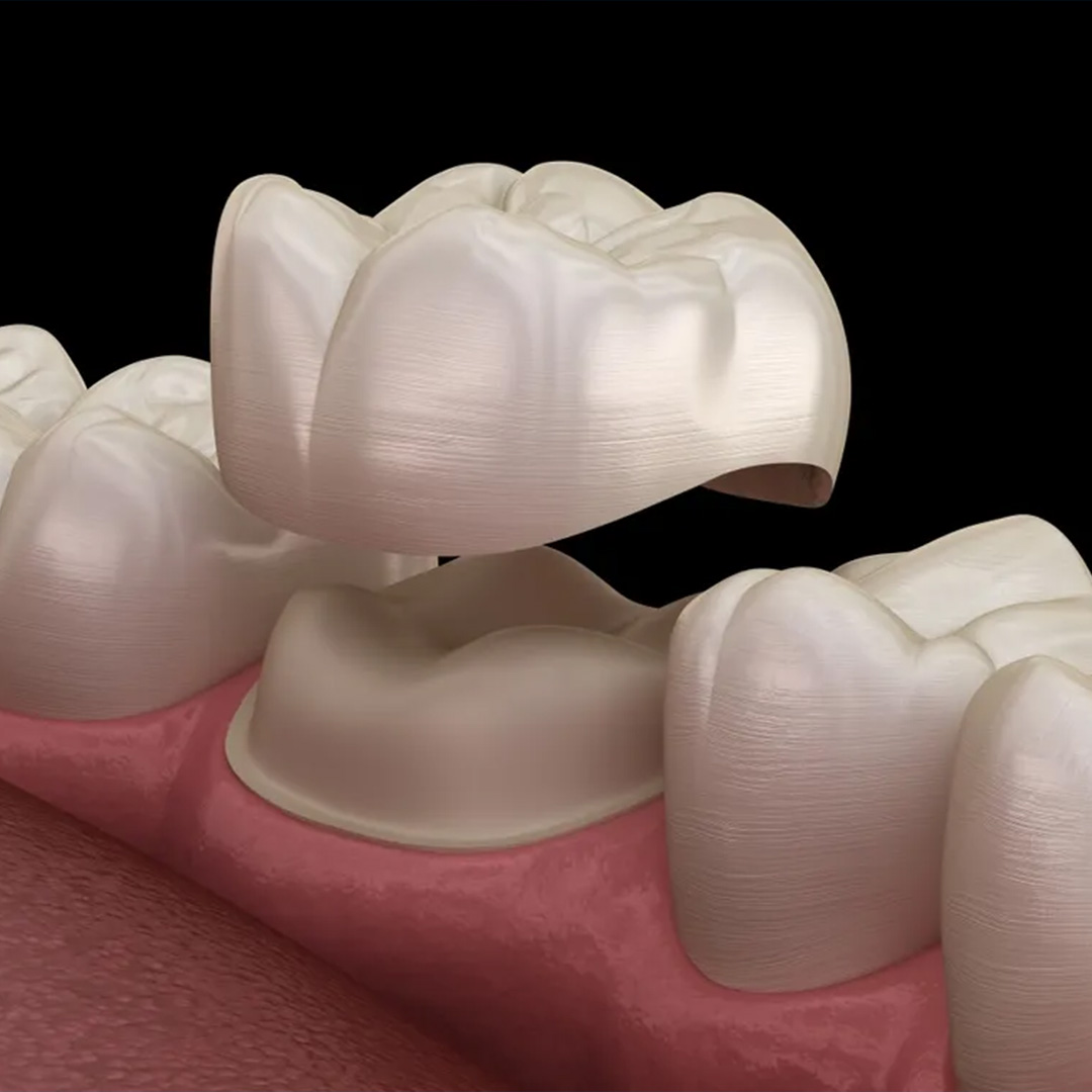 What is dental crown?