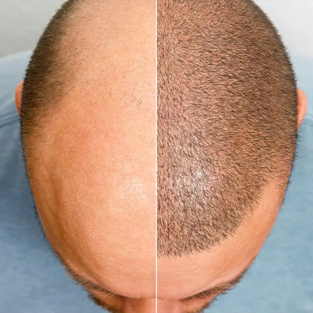 What are the FUE Hair Transplant Stages