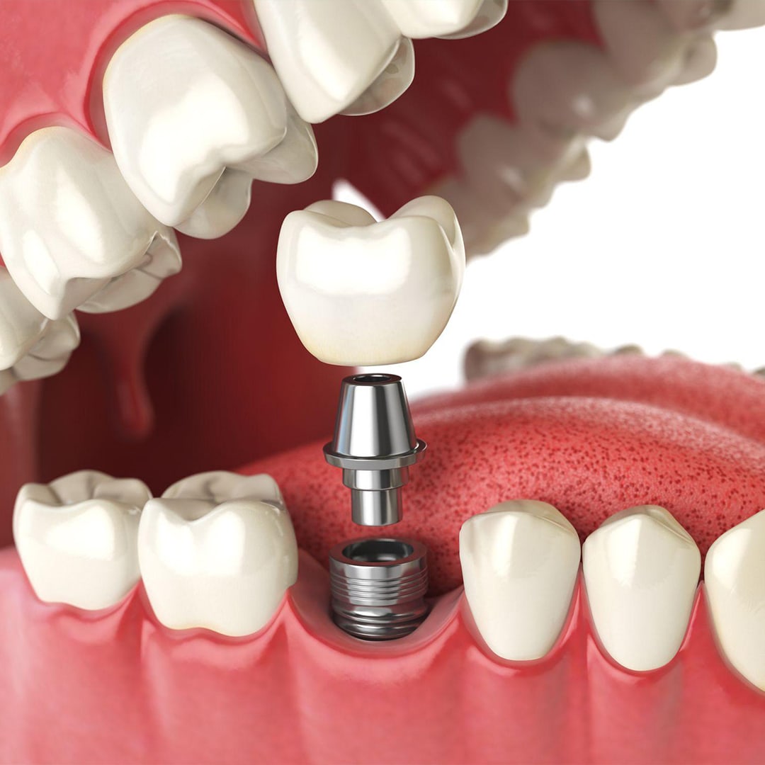 What You Need to Know About Implants