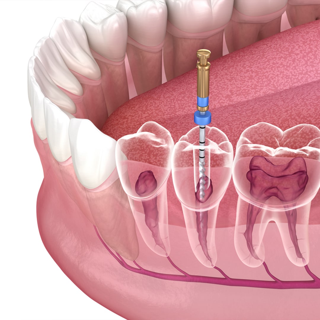 Root Canals img